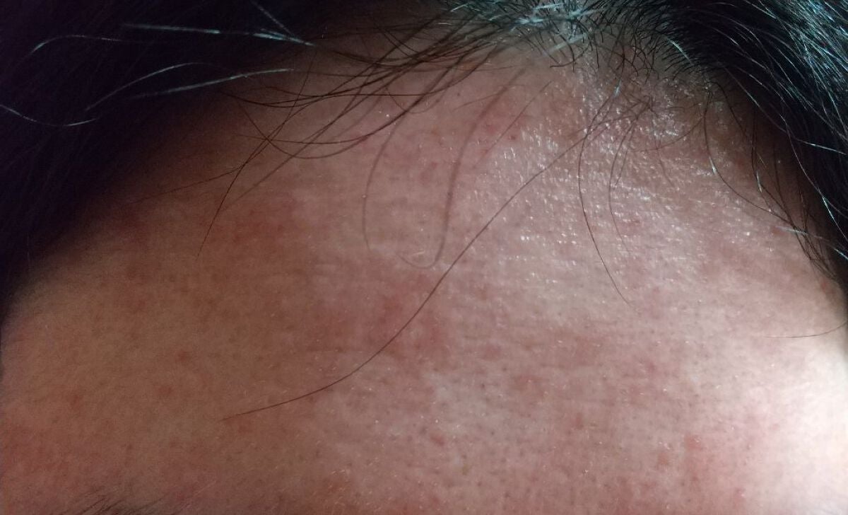 AZアゼライン酸10セラム/コスデバハ/美容液を使ったクチコミ(6枚目)