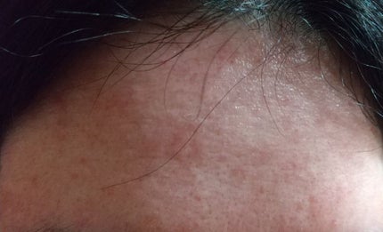 AZアゼライン酸10セラム/コスデバハ/美容液を使ったクチコミ(6枚目)