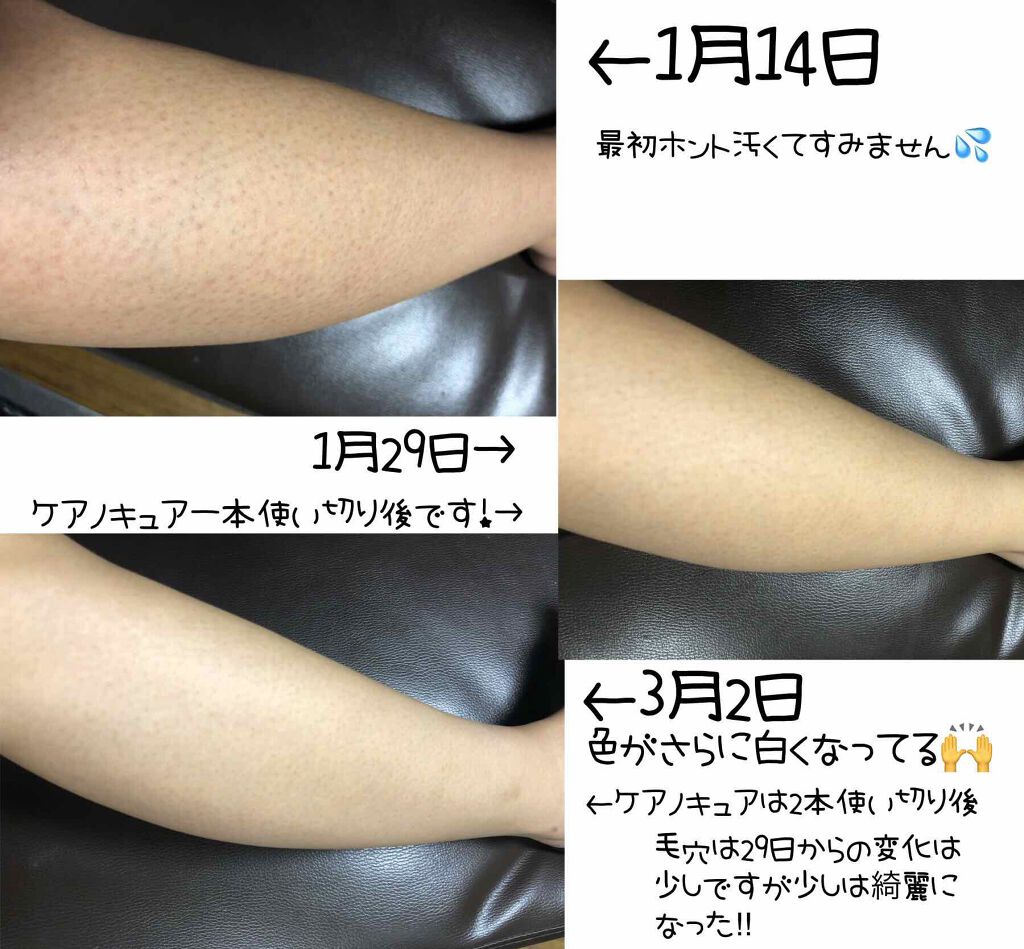 ケアノキュア 医薬品 小林製薬を使った口コミ 汚い足の画像あるので閲覧注意以前ケアノ By Lily 脂性肌 30代後半 Lips