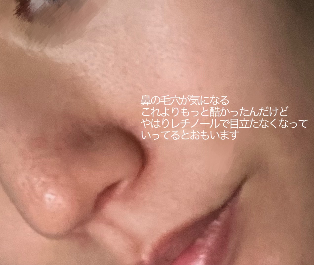 シカレチA エッセンス0.3/VT/美容液を使ったクチコミ（2枚目）