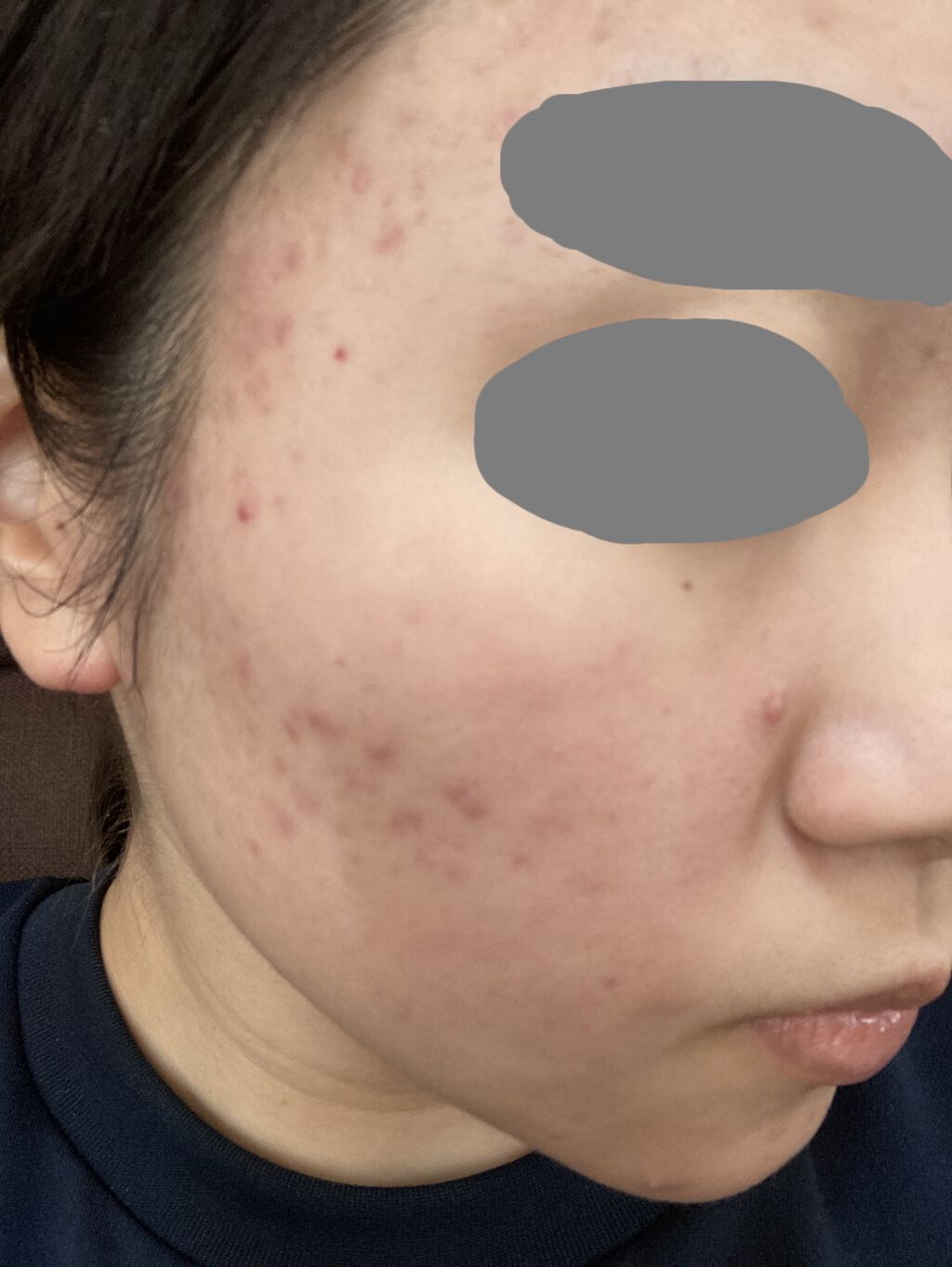 テラ・コートリル 軟膏(医薬品)/ジョンソン・エンド・ジョンソン/その他を使ったクチコミ（1枚目）