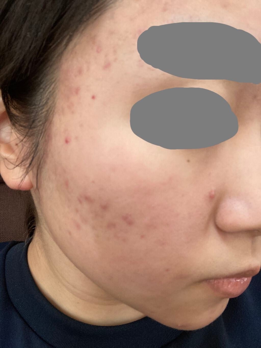 テラ・コートリル 軟膏(医薬品)/ジョンソン・エンド・ジョンソン/その他を使ったクチコミ(1枚目)