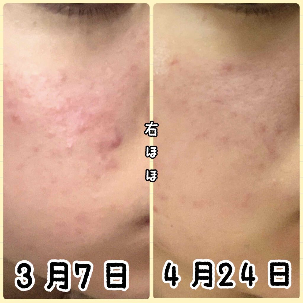 白潤 薬用美白化粧水(しっとりタイプ)/肌ラボ/化粧水を使ったクチコミ(2枚目)