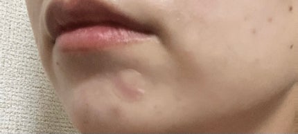 CICAティーツリークリアパッチ+/Angelab/にきびパッチを使ったクチコミ(4枚目)