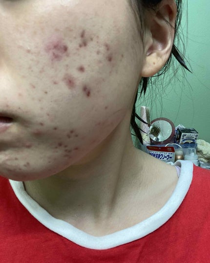 にきび治療薬C(医薬品)/ピンプリット/その他を使ったクチコミ(4枚目)