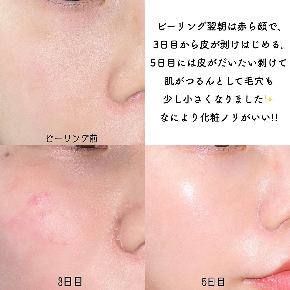 ダーマスキンピーリング/BQCELL/その他キットセットを使ったクチコミ(3枚目)