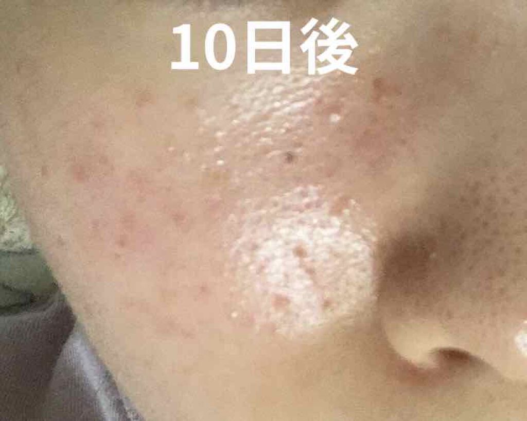 FDR アクネケア ジェル乳液/ファンケル/乳液を使ったクチコミ(3枚目)