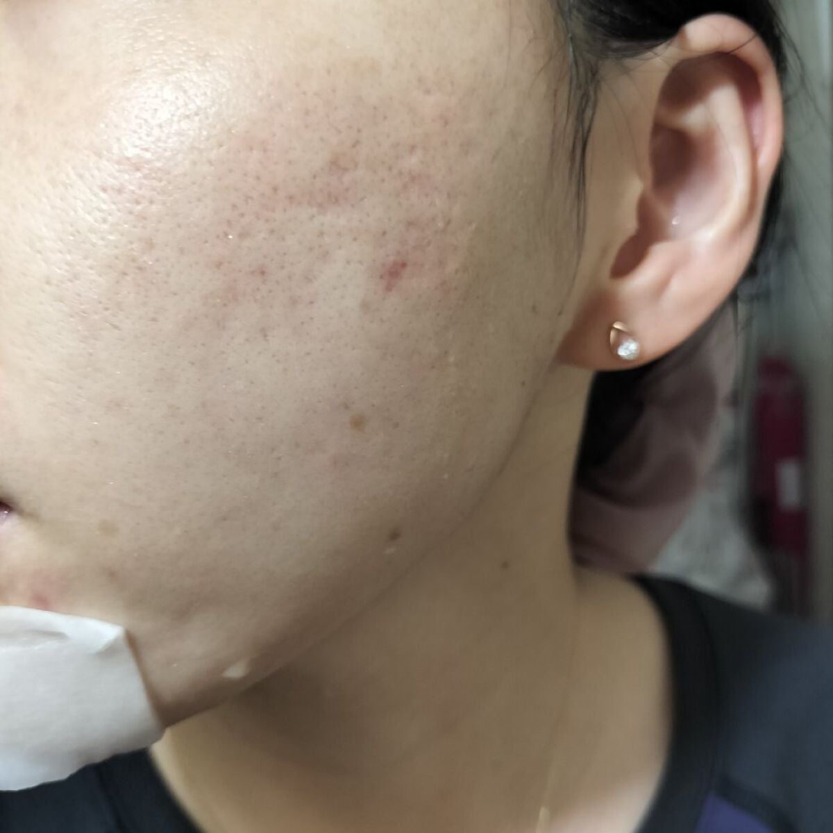 miina@汚肌工事録⚠️ on LIPS 「9/22の#汚肌工事録あーやっぱり毛穴開いてる💦20も21は帰..」(2枚目)