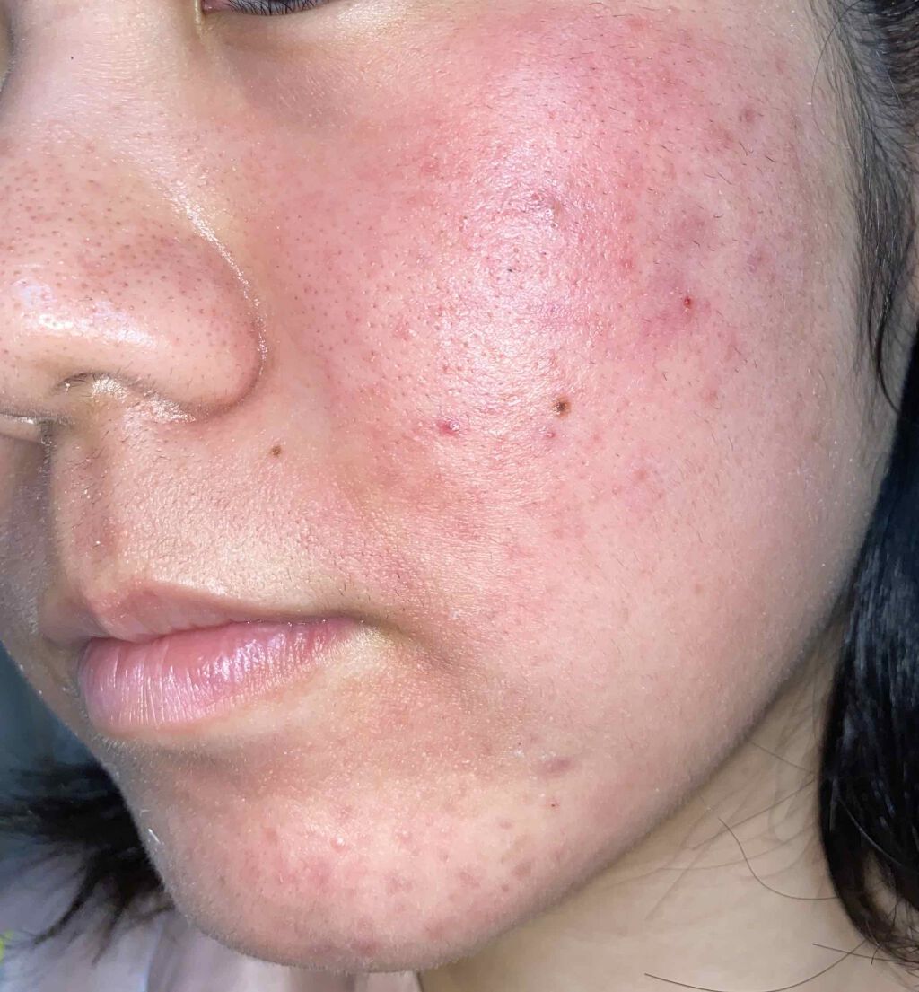 ベピオゲル/マルホ株式会社/その他を使ったクチコミ（3枚目）