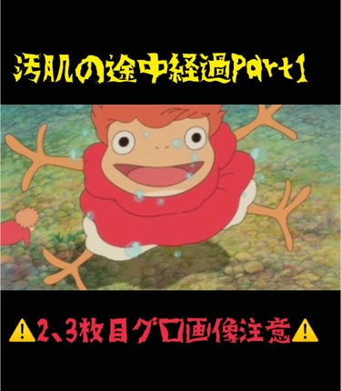 汚肌の途中経過お知らせ致します✋✋

2、3枚目ご覧の通り（まだまだニキビだらけですが…）少し改善されてきたような気がします！！

とにかくお肌に優しいものを使おうと
前回お知らせしたものの他に

（（