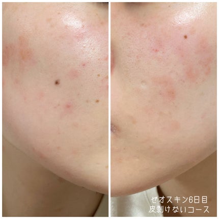 スキンブライセラム/ZO Skin Health/美容液を使ったクチコミ(3枚目)