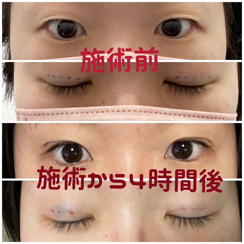ゆー on LIPS 「湘南美容外科でスクエア二重術していただきました!初めてで、めち..」(2枚目)