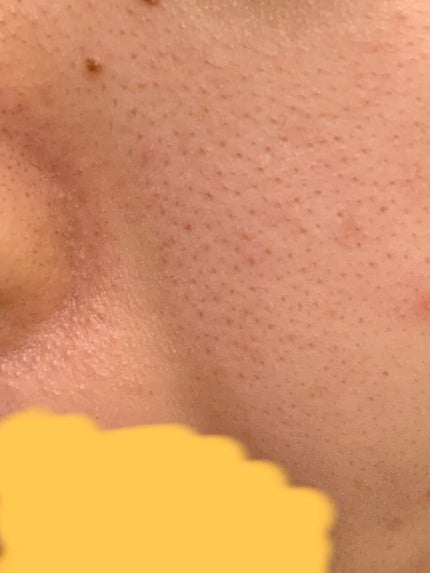 レトロな小松菜 on LIPS 「毛穴の黒ずみ、毛穴ケアについて!!こんにちは!今回は私の毛穴事..」(5枚目)