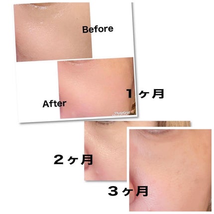 シカレチA エッセンス0.1/VT/美容液を使ったクチコミ(6枚目)