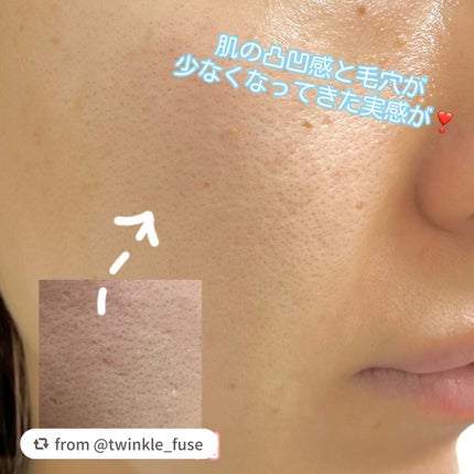 ユース ラディアンス ビタチノール セラム/primera/美容液を使ったクチコミ(3枚目)