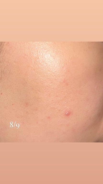 シカレチA クリーム0.05/VT/フェイスクリームを使ったクチコミ(4枚目)