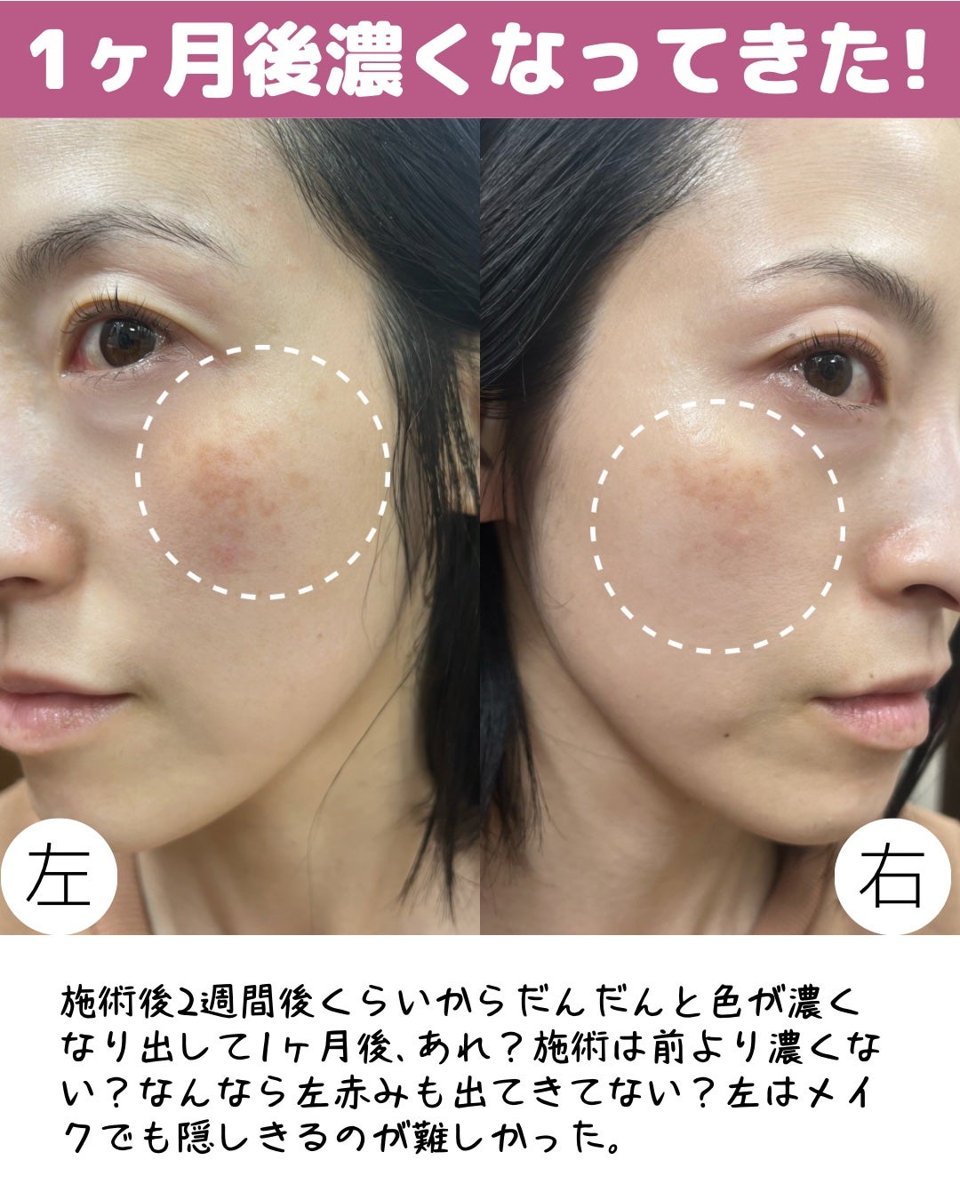 miisa/歳を重ねても"可愛い"をつくる美容法 on LIPS 「\悲しみ💔/そばかす取ったら衝撃の結末🫨𓇠𓇠𓇠𓇠𓇠𓇠𓇠𓇠𓇠𓇠𓇠..」(7枚目)