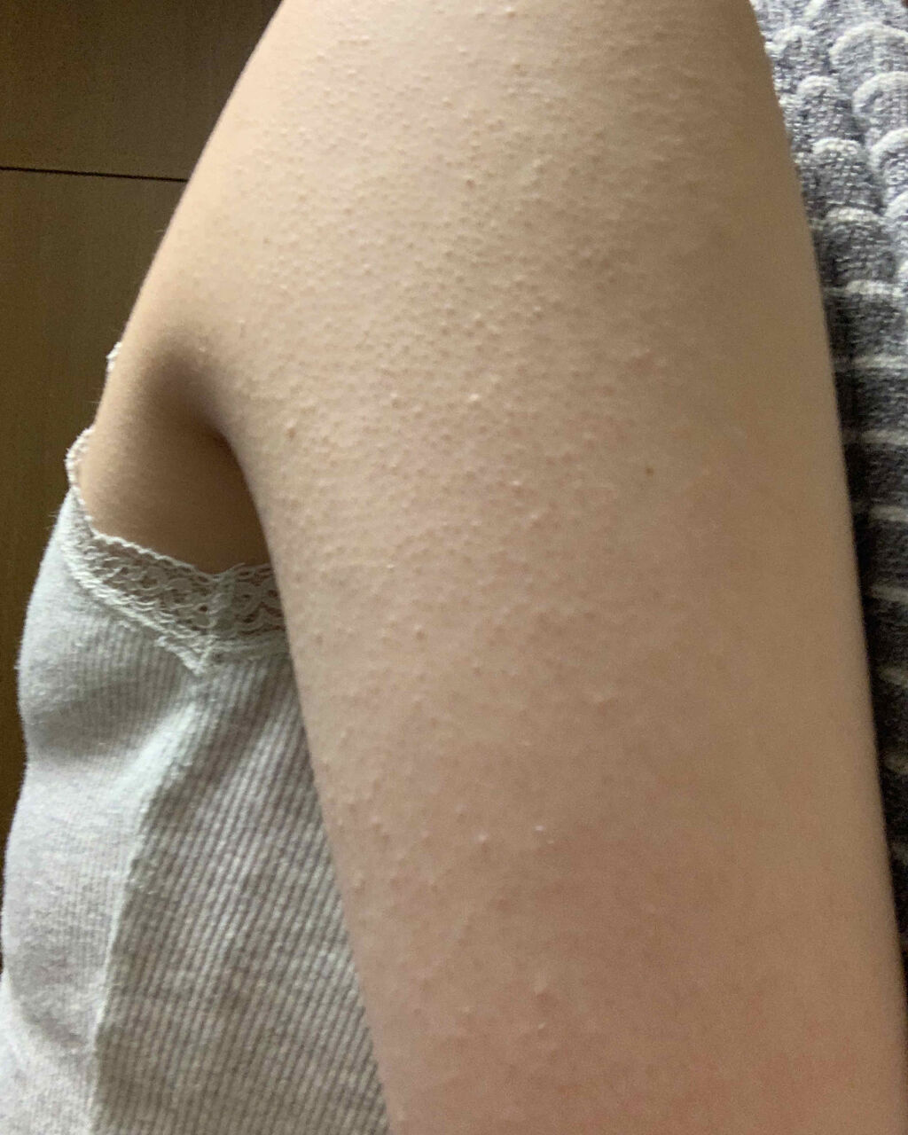 コーワ 尿素配合クリーム 医薬品 ケラチナミンの口コミ 汚い画像のせます ごめんなさい まだちゃん By Mizuki 乾燥肌 代後半 Lips