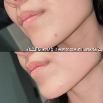 ビューティーミラクルパッチスポットカバー/Rael/にきびパッチを使ったクチコミ(6枚目)