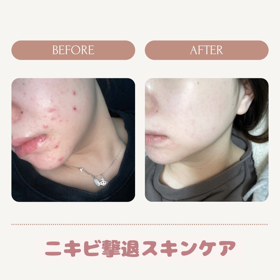 薬用雪肌精 ブライトニング エッセンス ローション/雪肌精/化粧水を使ったクチコミ(1枚目)