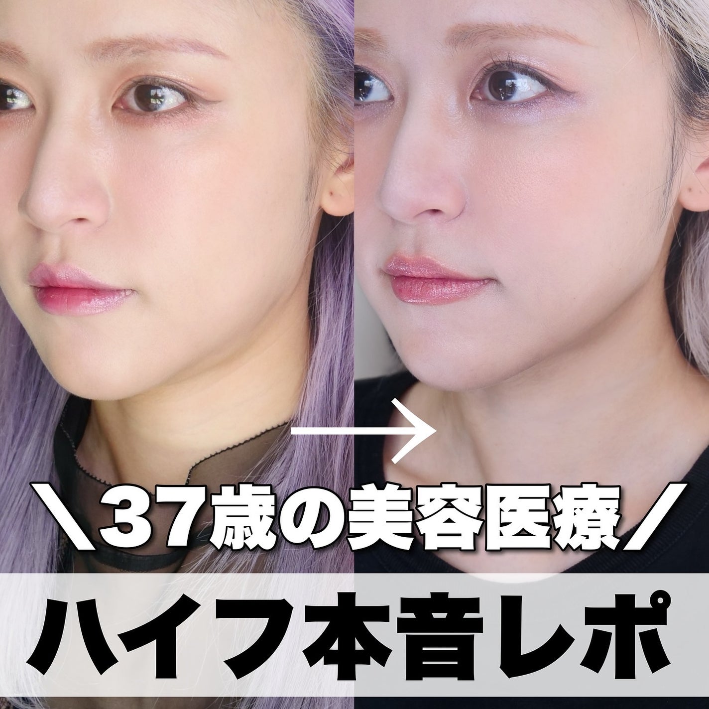 とみりー on LIPS 「ハイフ本音レポ!過去にも美容医療レポを何回もしていて、その時..」(1枚目)