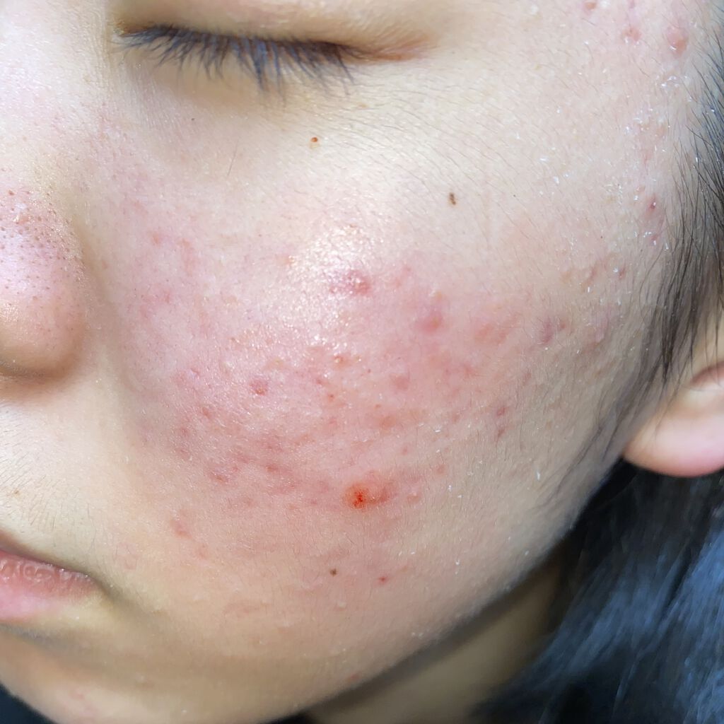 薬用保湿化粧水/オードムーゲ/化粧水を使ったクチコミ（2枚目）