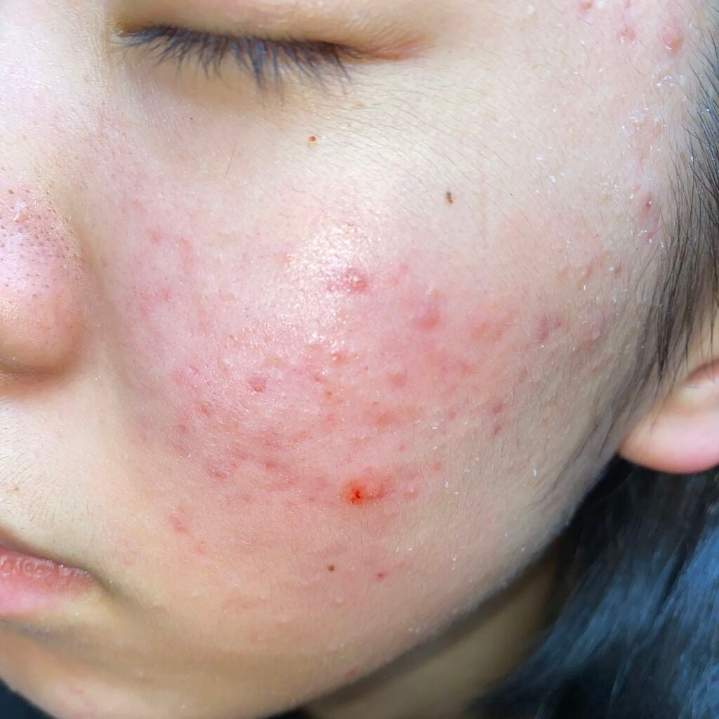 薬用保湿化粧水/オードムーゲ/化粧水を使ったクチコミ(2枚目)