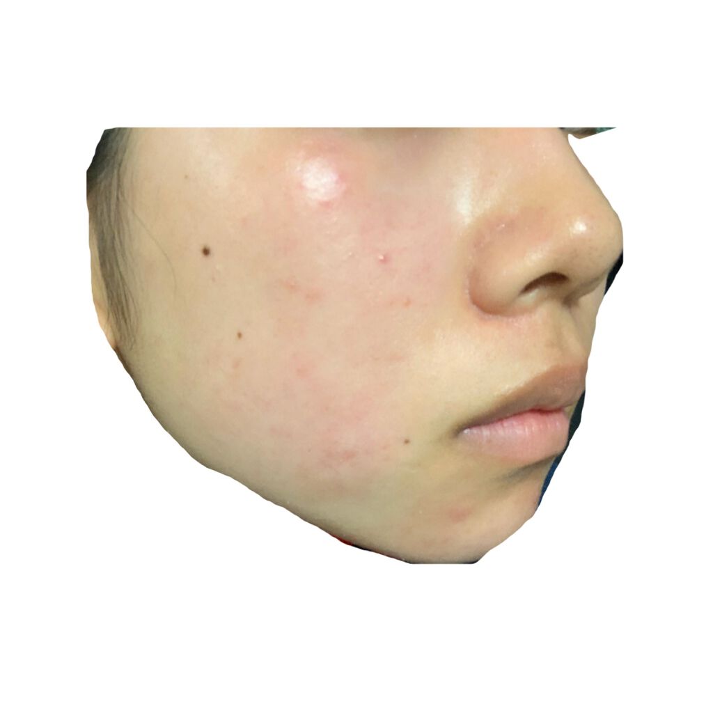 ベピオゲル/マルホ株式会社/その他を使ったクチコミ（1枚目）