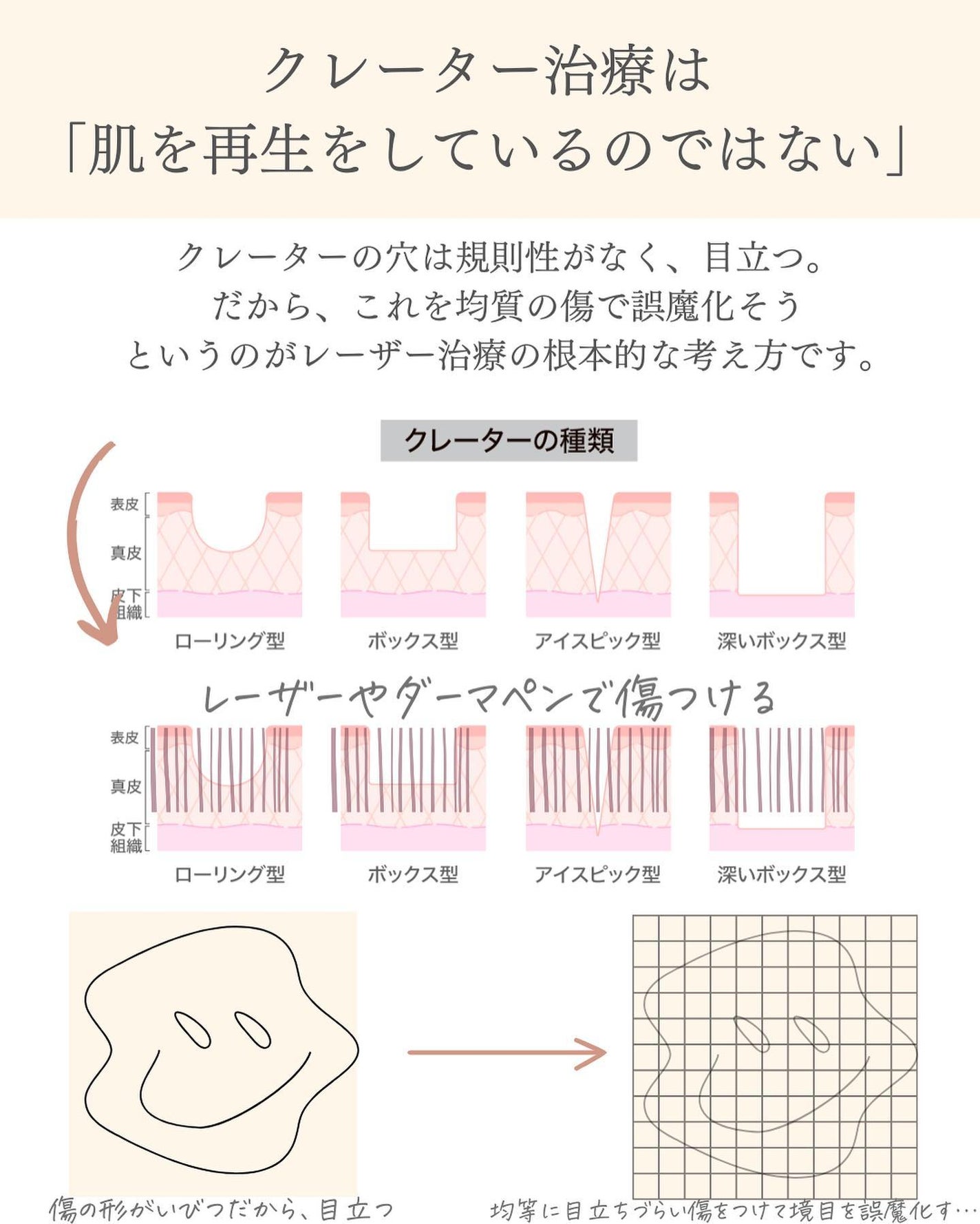 おゆみ|ニキビ・ニキビ跡ケア on LIPS 「【クレーター治療の基本のキ】こんばんは、おゆみです✨クレーター..」(2枚目)
