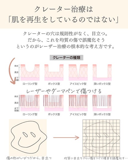 おゆみ|ニキビ・ニキビ跡ケア on LIPS 「【クレーター治療の基本のキ】こんばんは、おゆみです✨クレーター..」(2枚目)