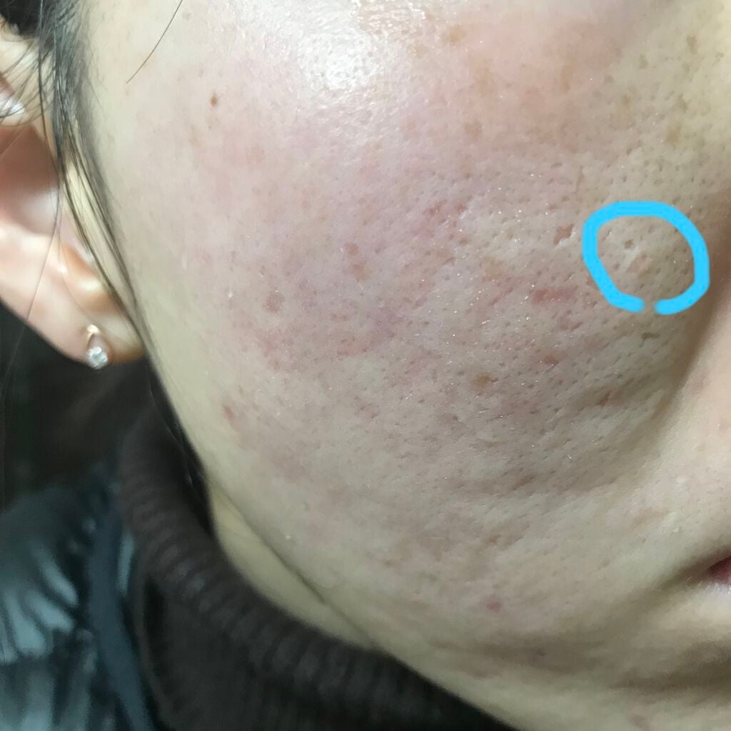 ティーツリーケア ソリューション エッセンシャルマスクEX/MEDIHEAL/シートマスク・パックを使ったクチコミ(3枚目)