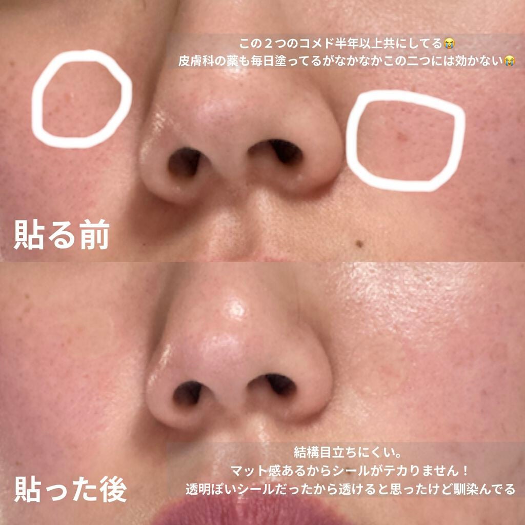 ハイドロコロイドスキンパッチ/ビューティーワールド/その他を使ったクチコミ(5枚目)