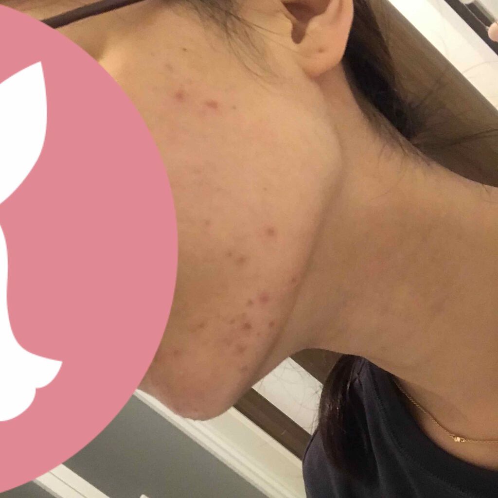 ペアアクネクリームW(医薬品)/ペア/その他を使ったクチコミ（2枚目）