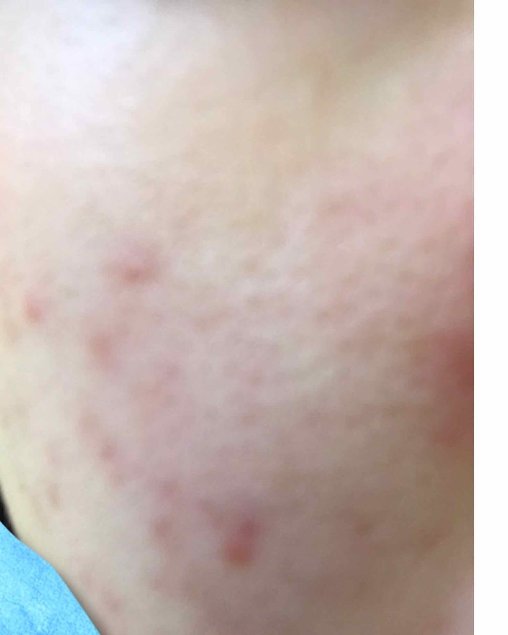 バイオイル/バイオイル/フェイスオイルを使ったクチコミ(2枚目)