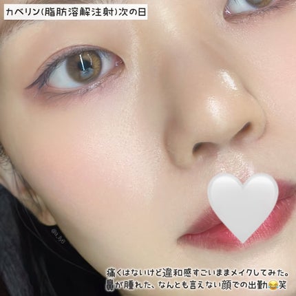 ããã㌠ðð€ãã©ãã on LIPS ããçŸå®¹å»çãå°éŒ»ã«ã«ããªã³(èèªæº¶è§£æ³šå°)æã£ãŠã¿ãðÂŽ-â¡ïŒŒ..ãïŒ4æç®ïŒ