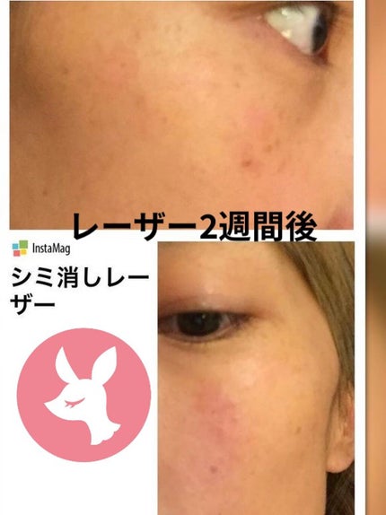 ためしたがり43歳 on LIPS 「これは、シミと戦争をした私の話。産後を含め、シミめっちゃ増えて..」(6枚目)