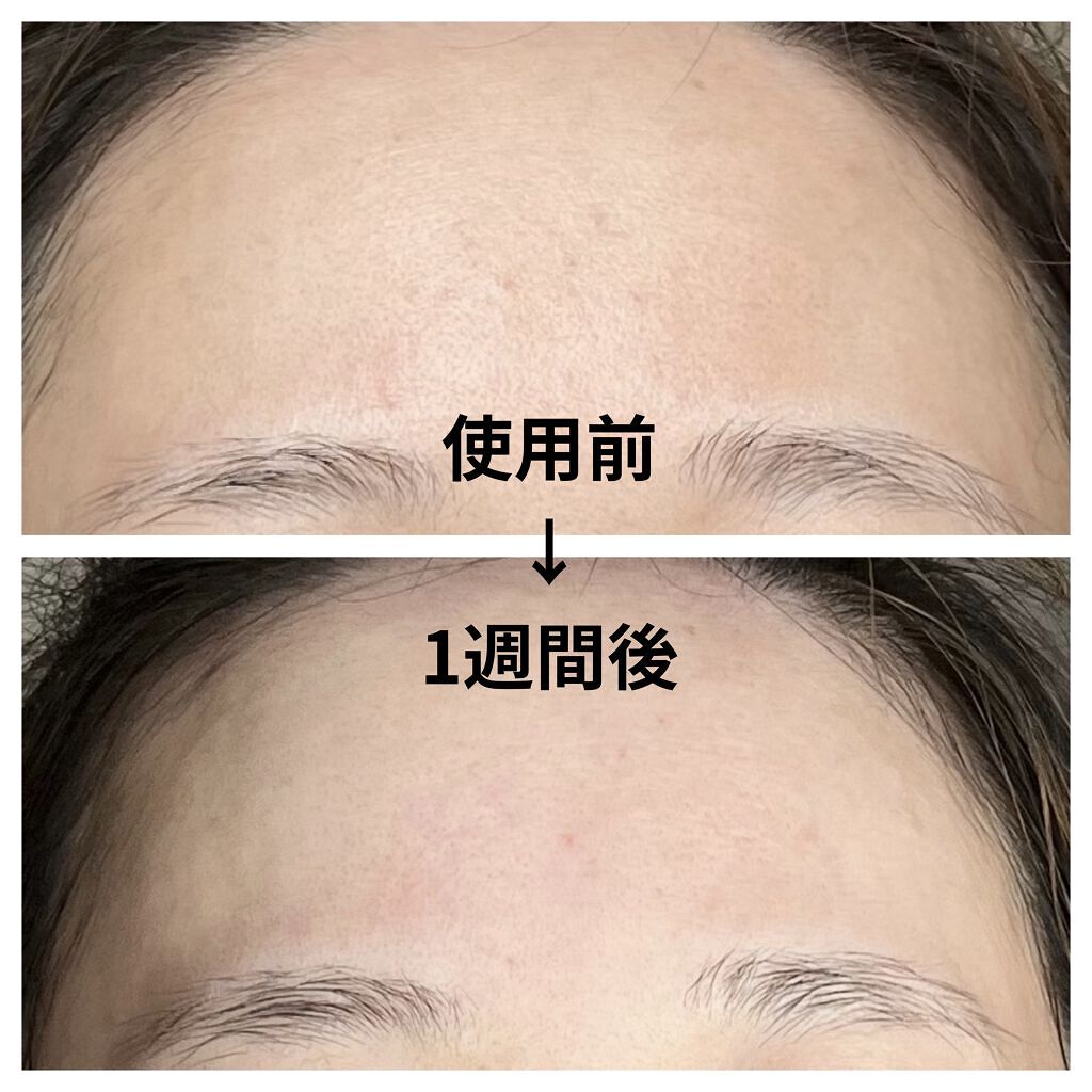 ドクダミ 77 スージングトナー/Anua/化粧水を使ったクチコミ（3枚目）