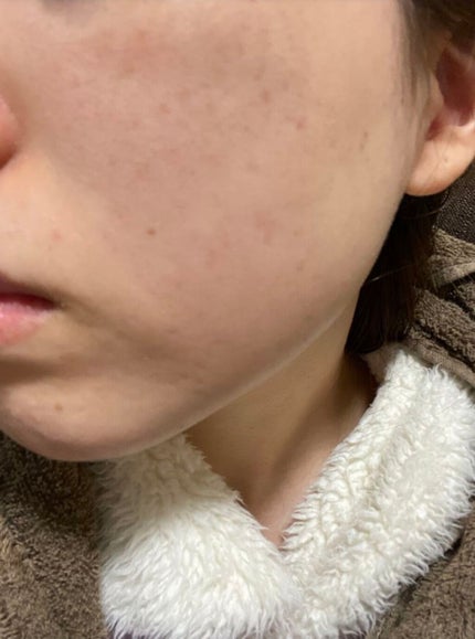 アピットジェル/全薬工業/美容液を使ったクチコミ(3枚目)