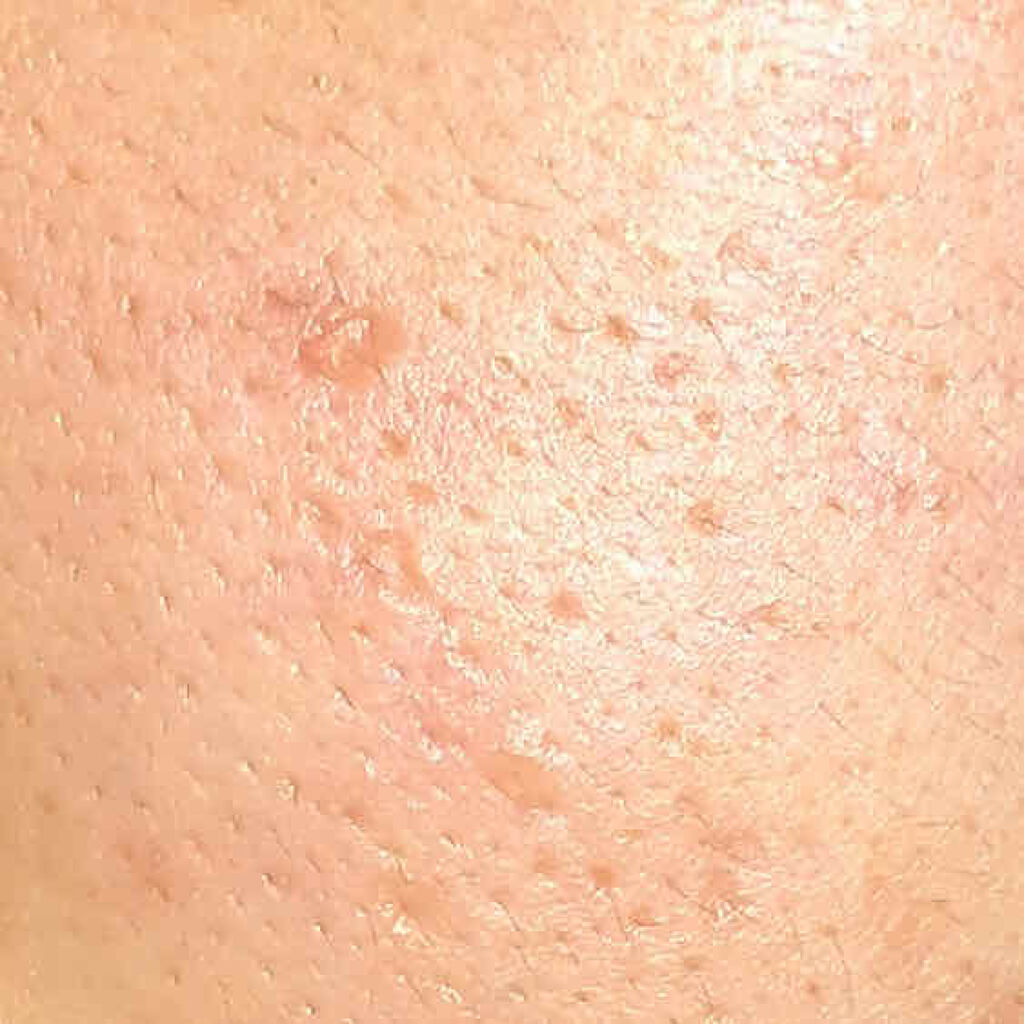 クラリファイング ローション 2/CLINIQUE/拭き取り化粧水を使ったクチコミ（2枚目）