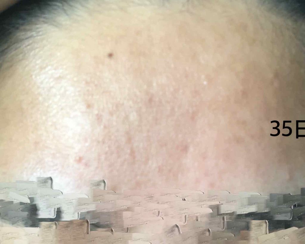 ようこ on LIPS 「※画像2枚目3枚目治療開始1日目と35日目の肌の写真ありますお..」(3枚目)