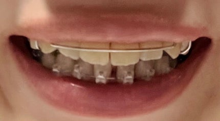 ハナ on LIPS 「矯正4回目(ワイヤー1回目)下の歯にワイヤーがつきました!!!..」(4枚目)