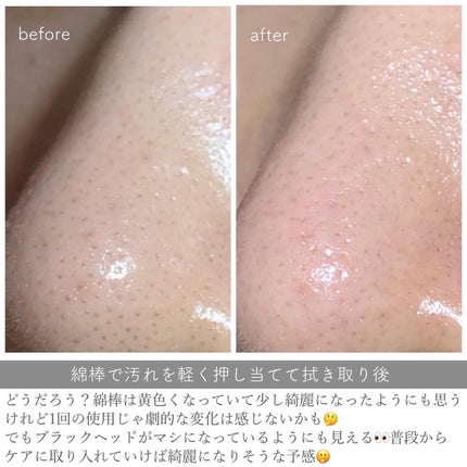 アクレオンセボエクストラクター/ANACIS/その他スキンケアを使ったクチコミ(4枚目)