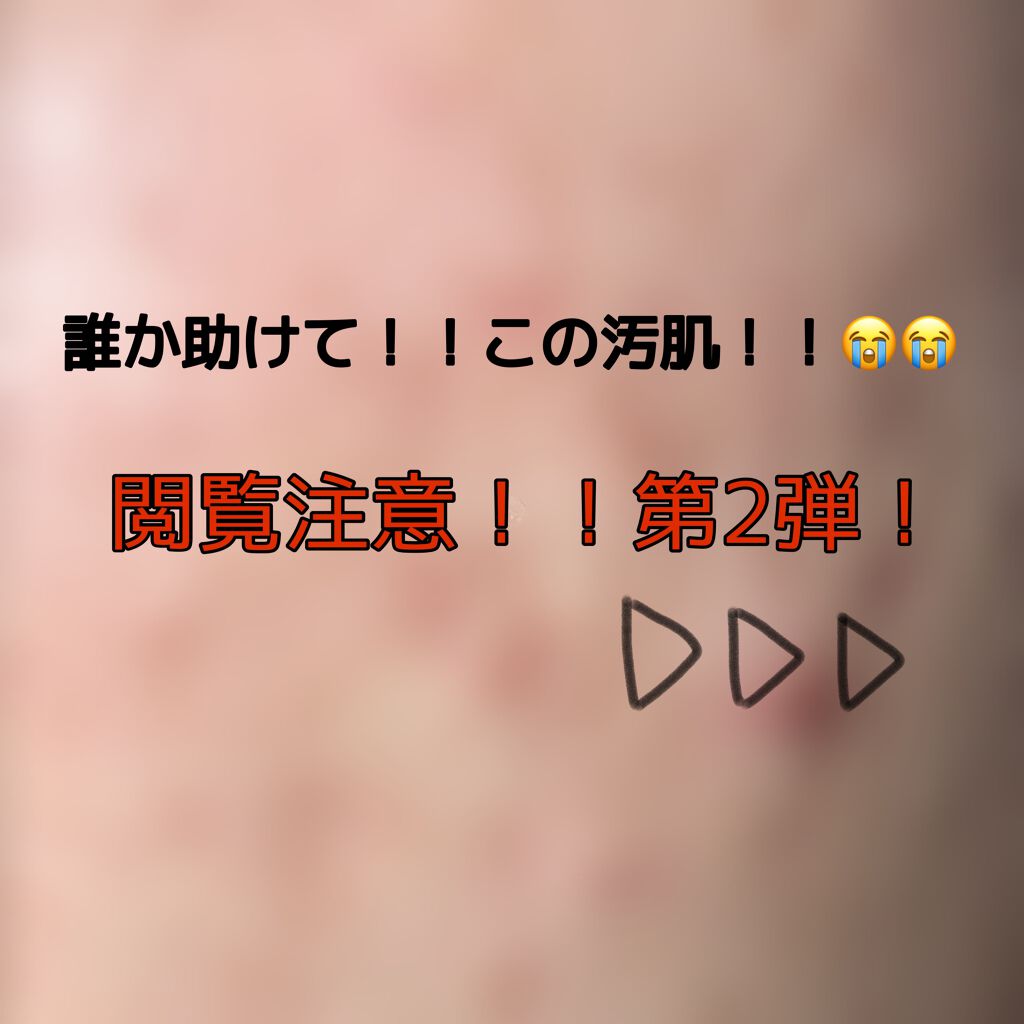 ちゃろ on LIPS 「前回の鼻の毛穴に続く第2弾ニキビ&ニキビ跡だらけの汚肌です😭😭..」(1枚目)
