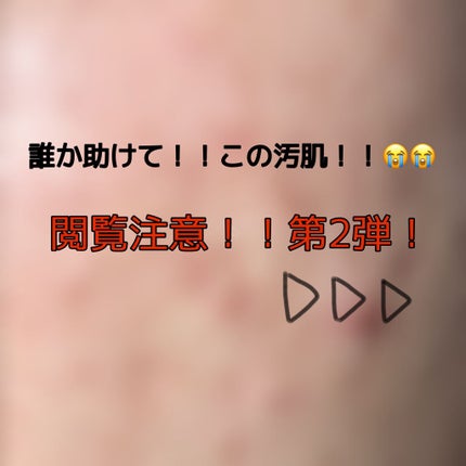 ちゃろ on LIPS 「前回の鼻の毛穴に続く第2弾ニキビ&ニキビ跡だらけの汚肌です😭😭..」(1枚目)