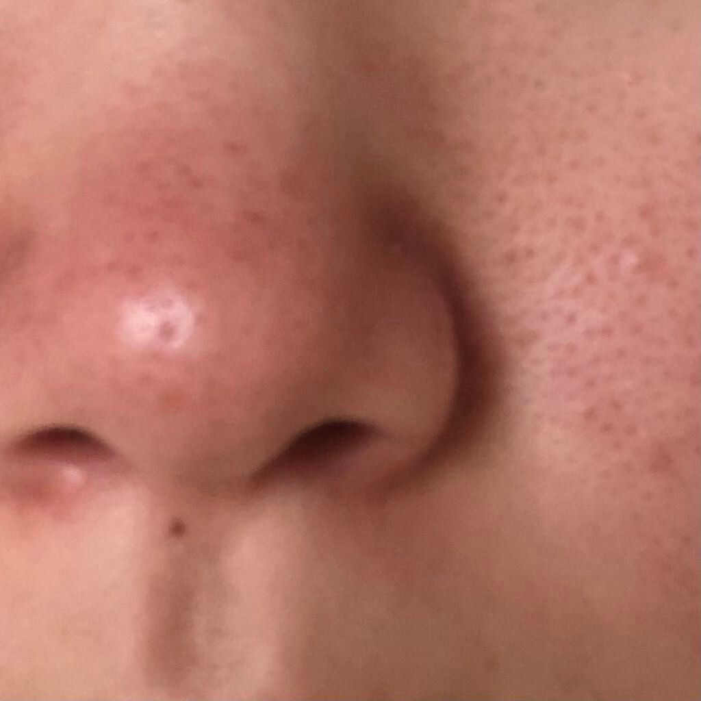 Shurn______% on LIPS 「毛穴ってどうすれば治りますか?開き毛穴すぎて改善策がみあたりま..」(3枚目)