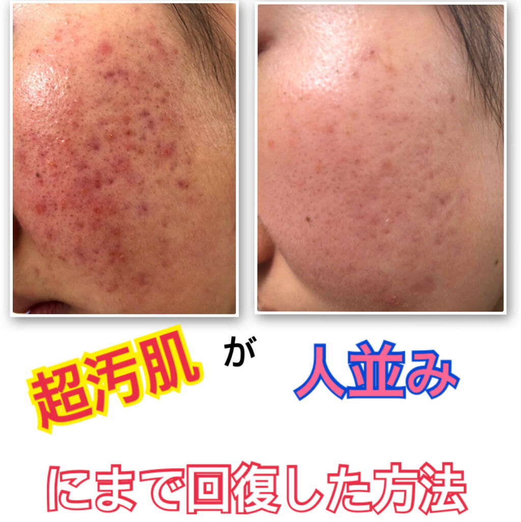 スキンケア方法 化粧水 敏感肌用 高保湿タイプ 無印良品の使い方 効果 超汚肌が人並み 少し By コヒ 混合肌 10代後半 Lips