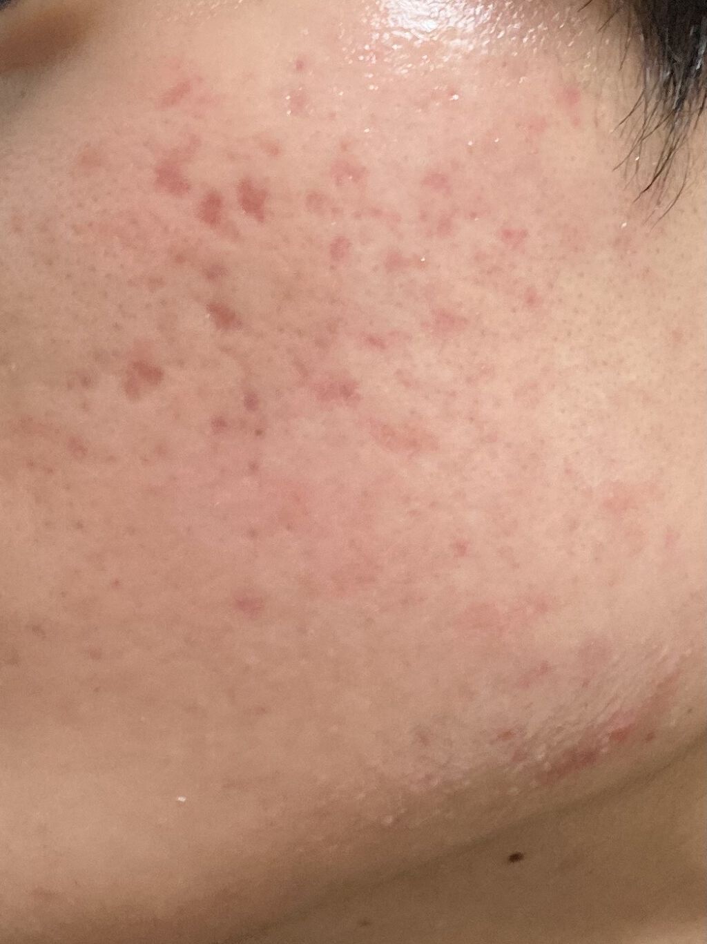 エピデュオゲル/マルホ株式会社/その他を使ったクチコミ（2枚目）