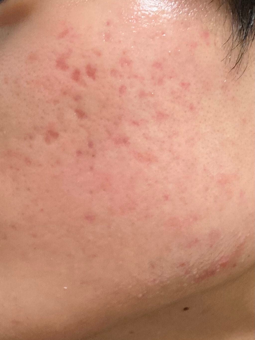 閲覧注意 on LIPS 「エピデュオ使用開始から約4ヶ月ニキビは出来にくくなってきたもの..」(2枚目)