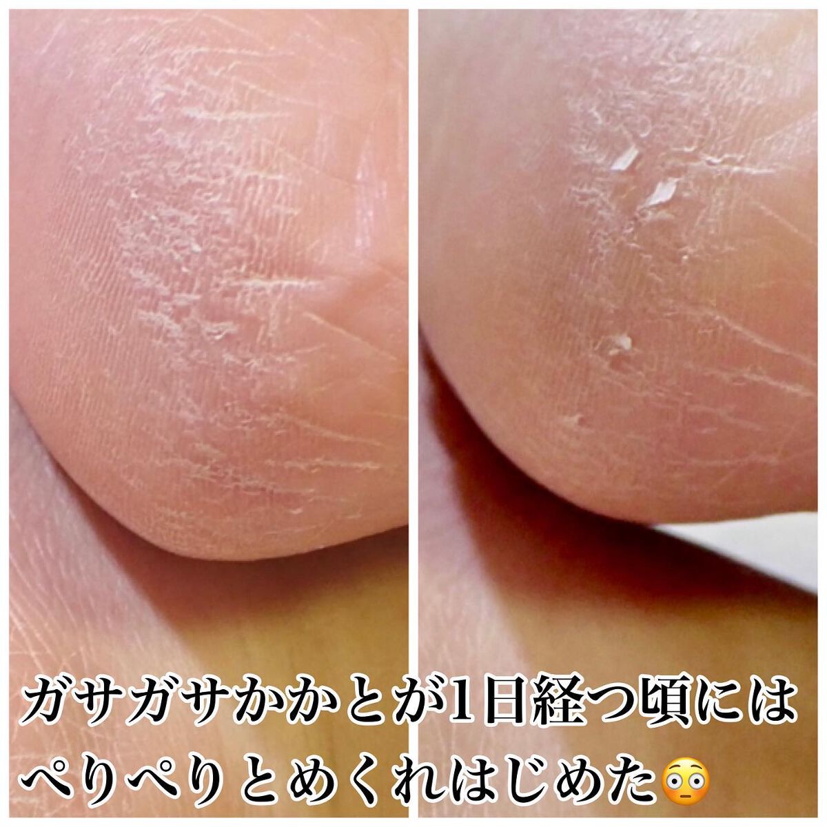 イージーパックDP60分タイプ/ベビーフット/レッグ・フットケアを使ったクチコミ(9枚目)