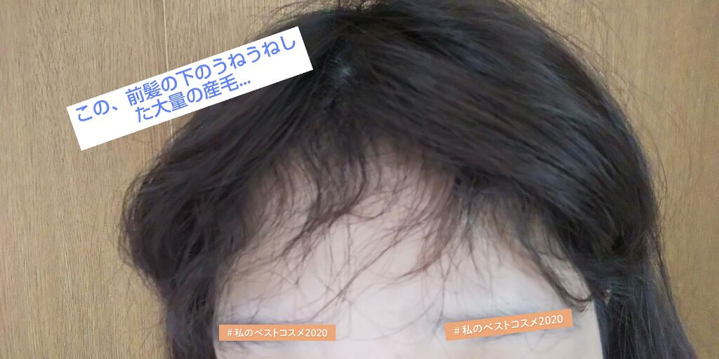 おもち on LIPS 「前髪の下のうねうねした産毛の無くし方・処理の仕方・対処法などを..」(2枚目)